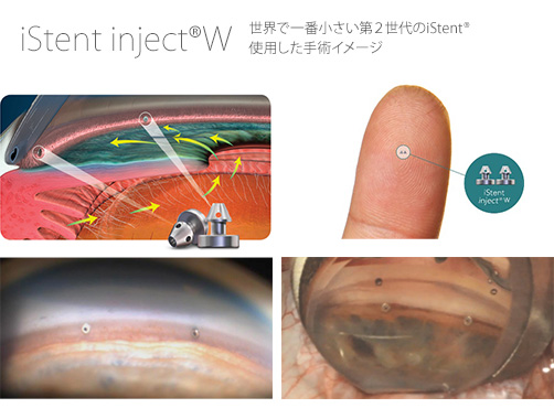 世界で一番小さい第２世代のiStent®　使用した手術イメージ
