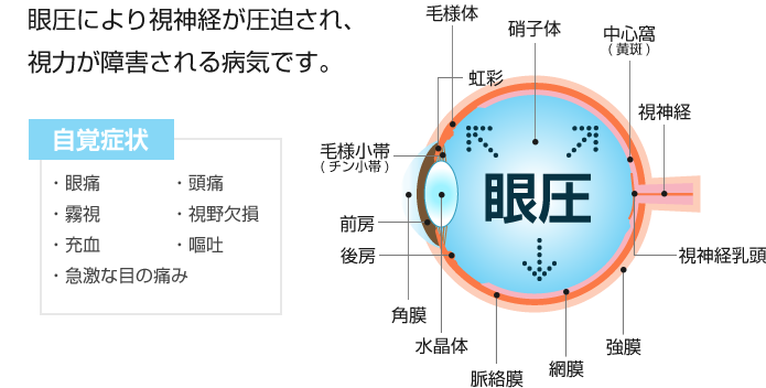 眼圧により視神経が圧迫され、視力が障害される病気です。