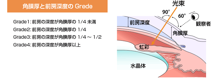 角膜厚と前房深度のGrede