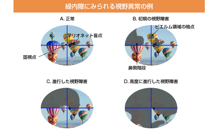 緑内障にみられる視野異常の例